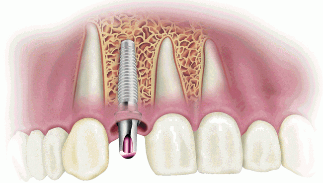 Dentist Montenegro Implantati