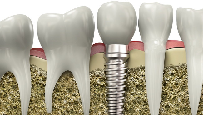 Implantati | Dentist Montenegro Dentist Montenegro Implantati