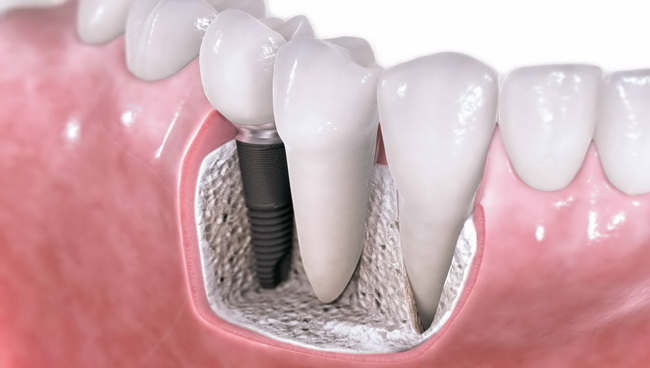 Implantati | Dentist Montenegro Dentist Montenegro Implantati