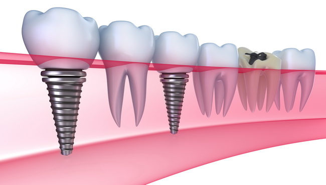 Implantati | Dentist Montenegro Dentist Montenegro Implantati