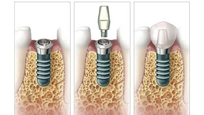 Implantati | Dentist Montenegro Dentist Montenegro Implantati